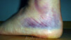 A ce stade, il vaudrait mieux éviter d'avoir à faire un alcotest. Ligaments_002